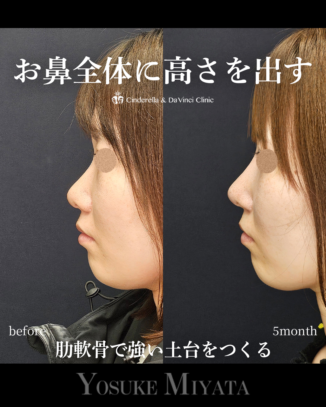お鼻全体に高さを出すの画像
