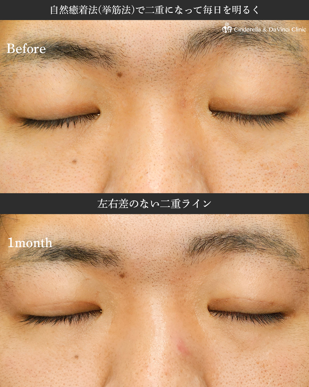 二重埋没でナチュラル印象チェンジの画像