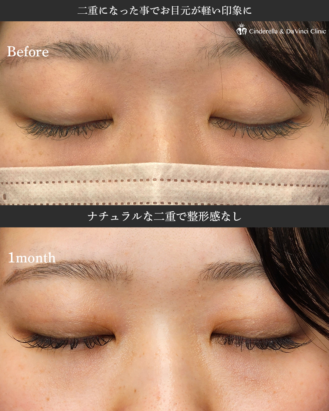 ナチュラル二重で整形感なしの画像