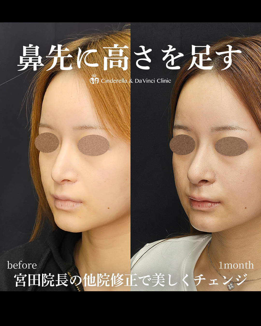 鼻の他院修正で美しくチェンジの画像