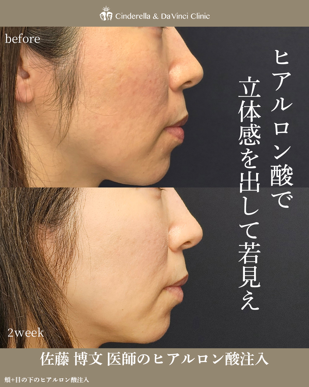 立体感をプラスして若見えの画像