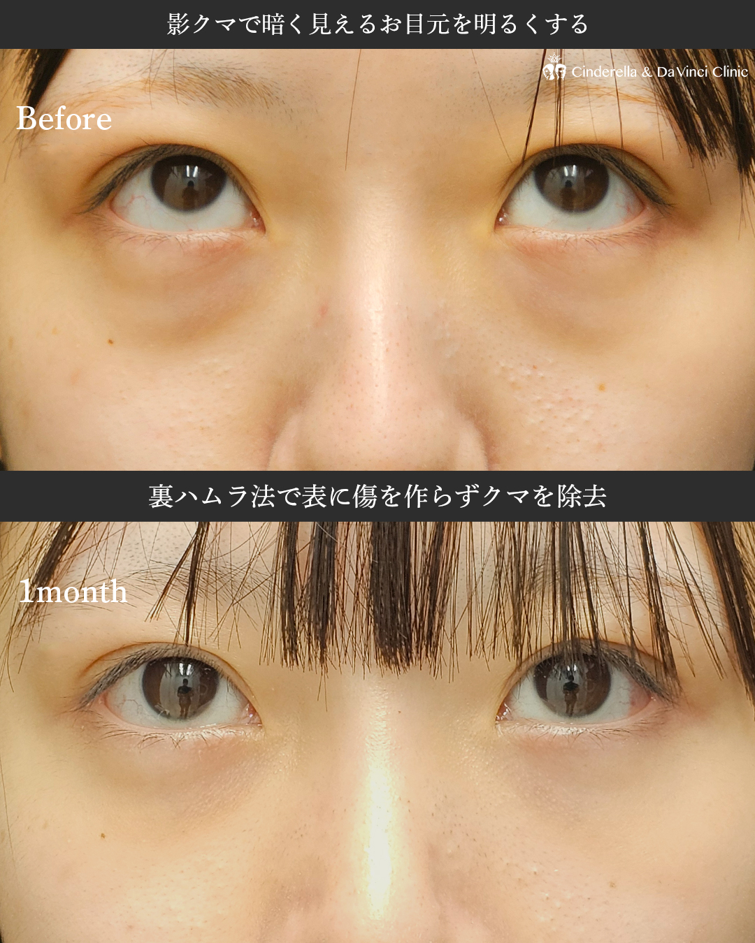 影クマ改善でお目元明るくの画像