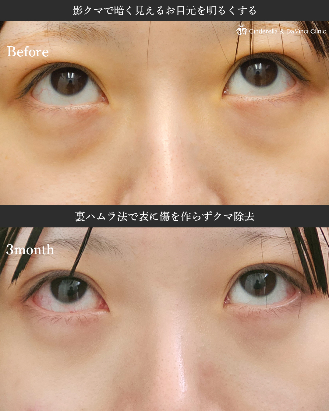 影クマ改善でお目元明るくの画像