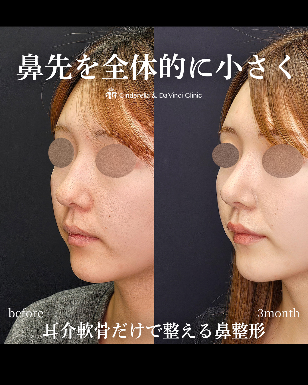 鼻先を全体的に小さくの画像