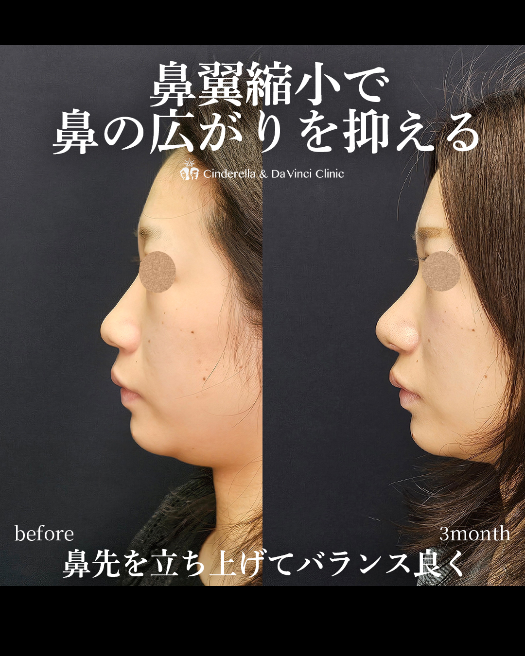鼻の広がりを抑えるの画像