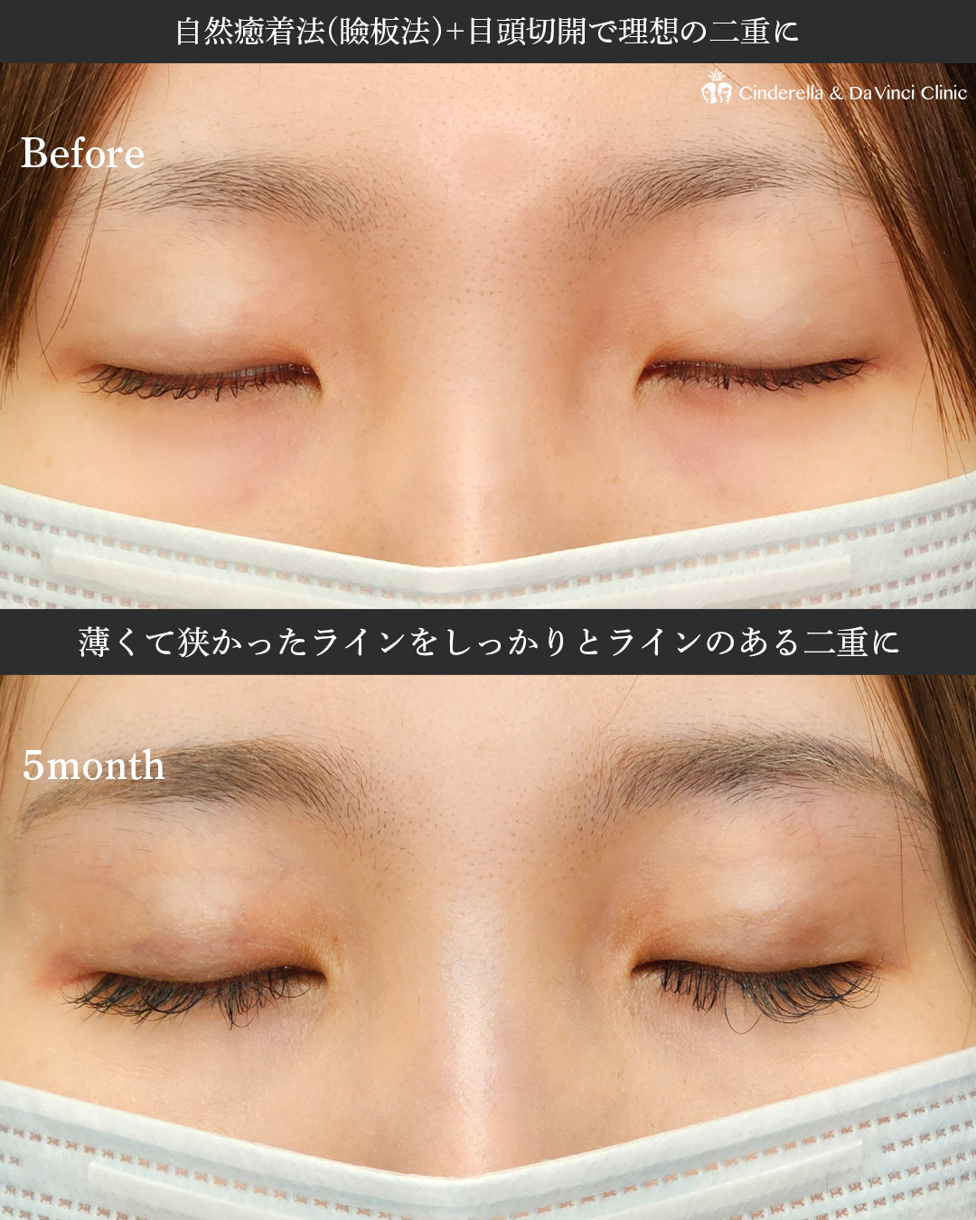 同時施術で目を大きく見せるの画像