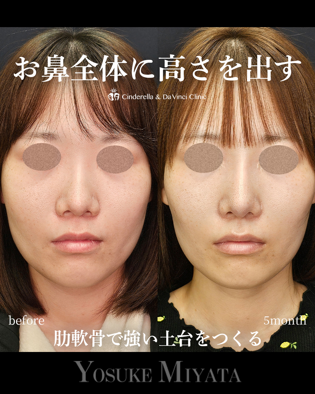 お鼻全体に高さを出すの画像