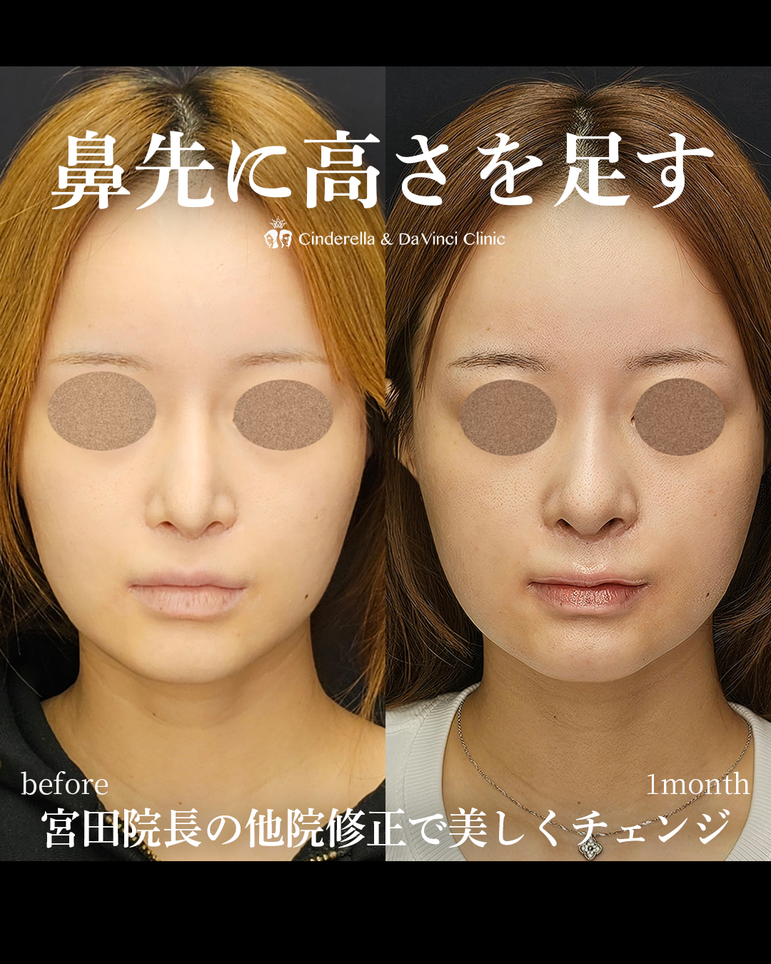 鼻の他院修正で美しくチェンジの画像