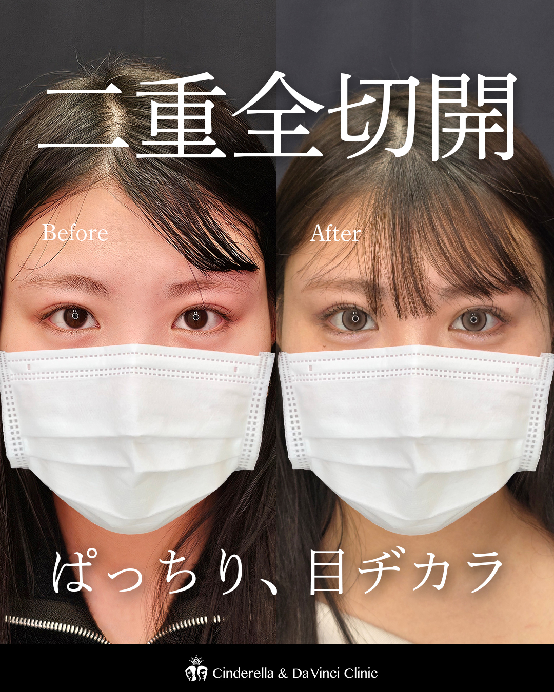 ダウンタイムを感じさせない全切開の画像
