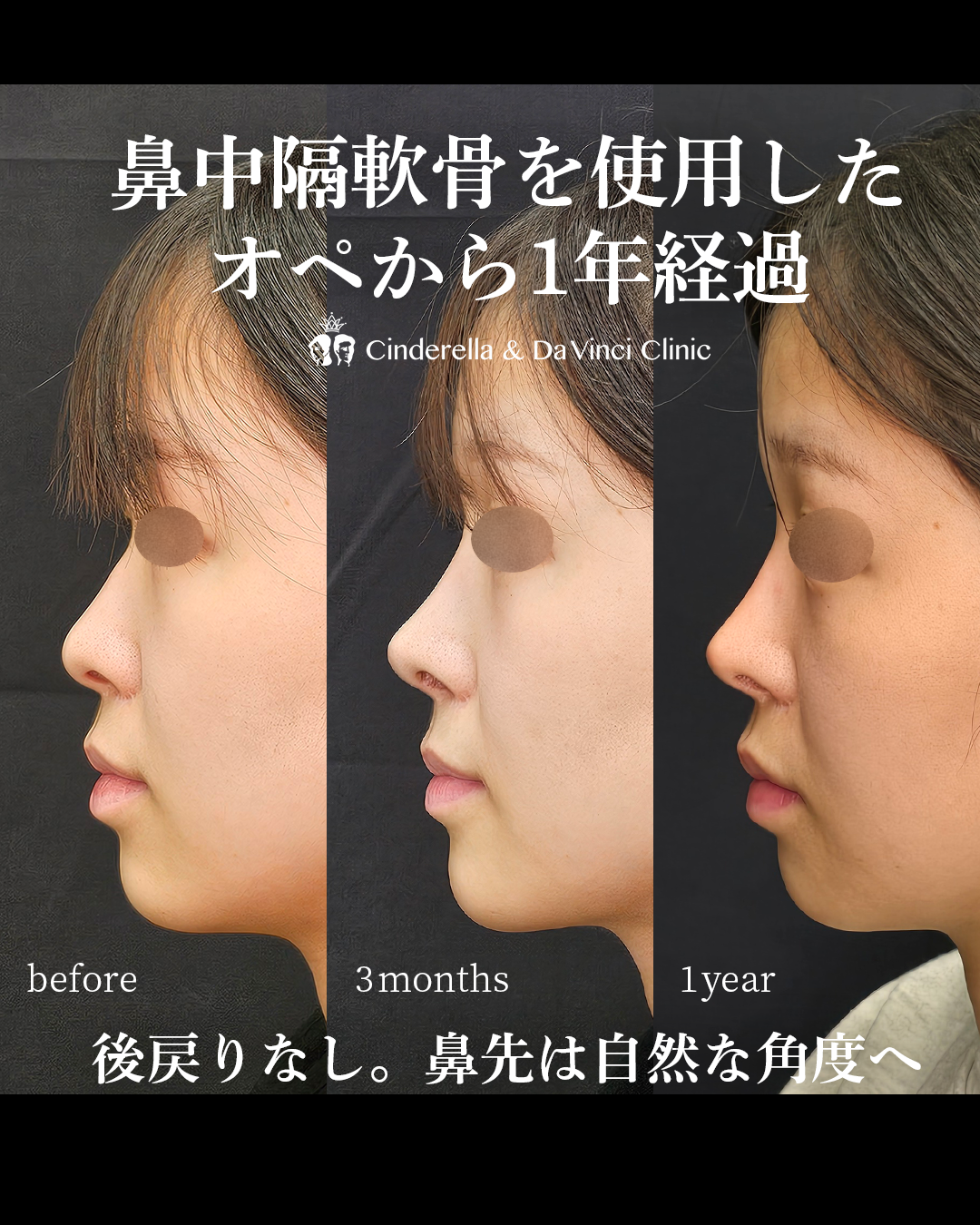 鼻中隔軟骨を使った長期症例の画像