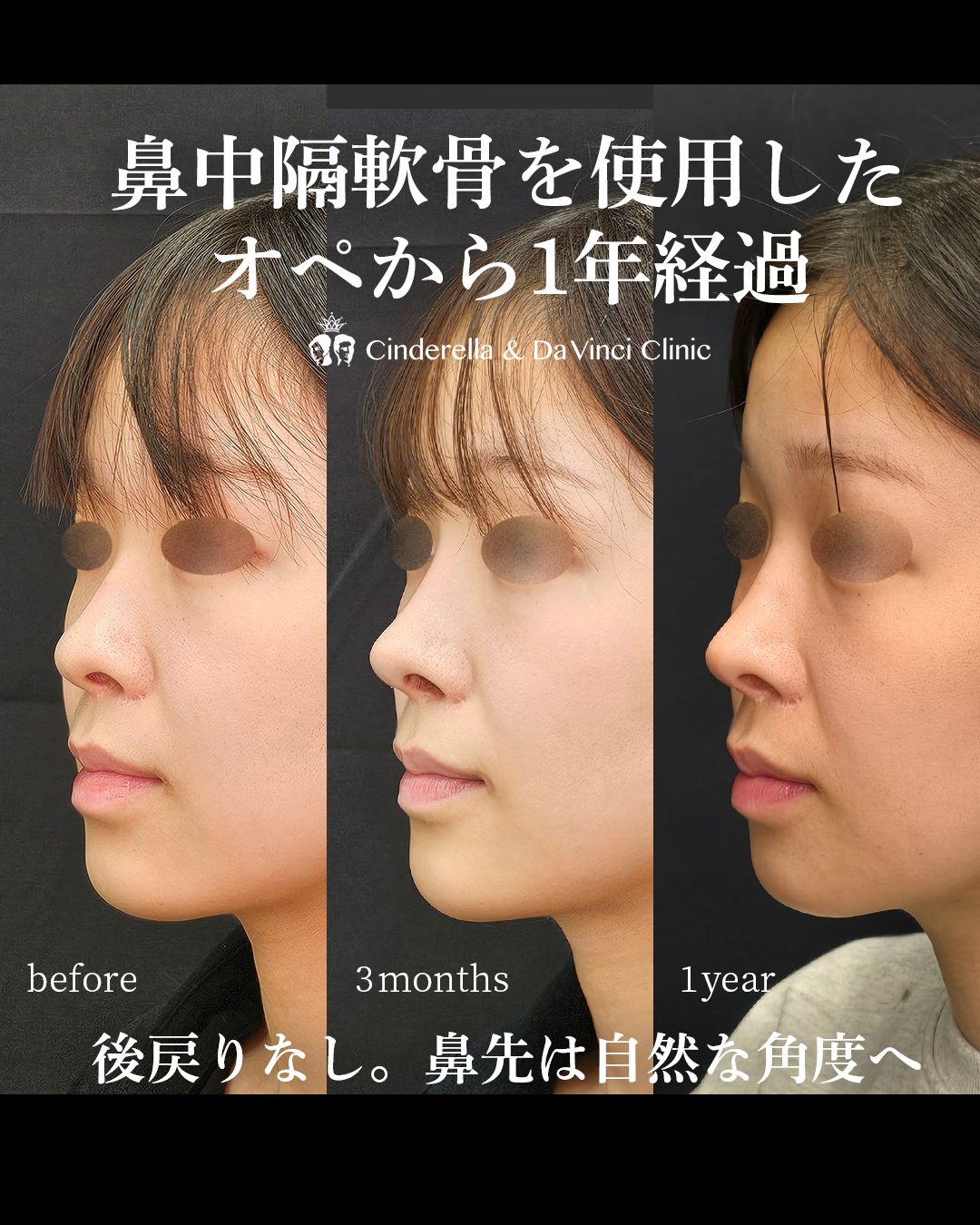 鼻中隔軟骨を使った長期症例の画像