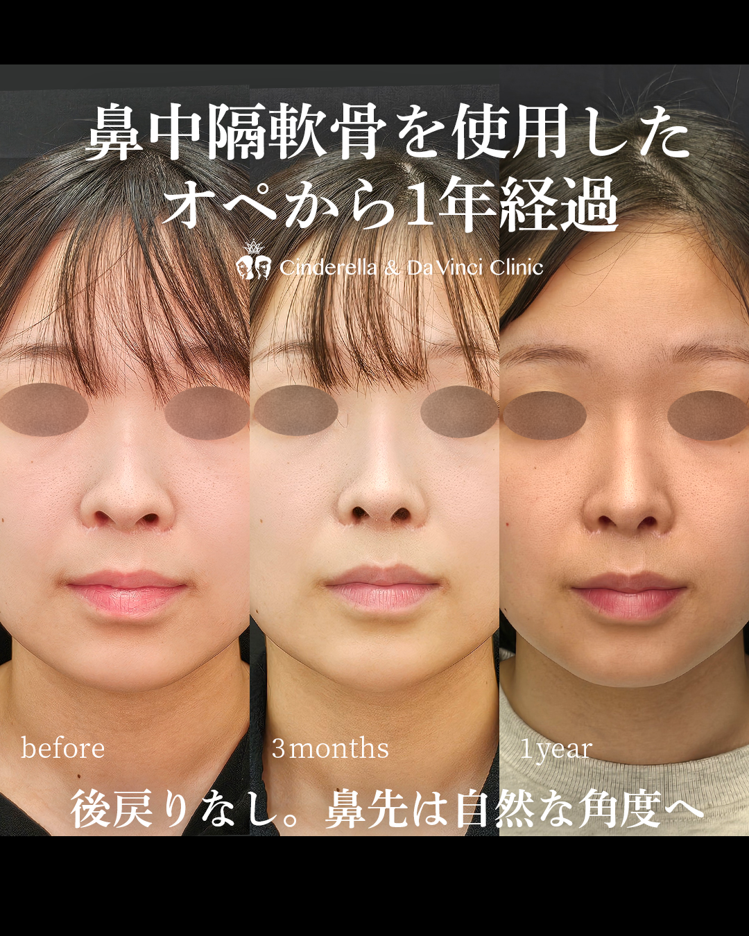 鼻中隔軟骨を使った長期症例の画像