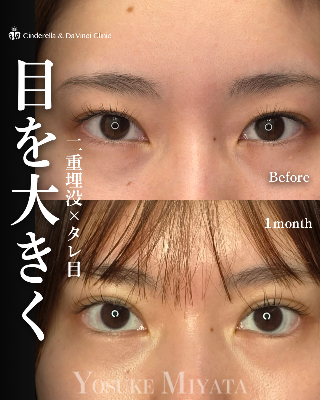 目を大きくする | 名古屋の美容外科・美容皮膚科ならCinderella & Da Vinci Clinic【公式】