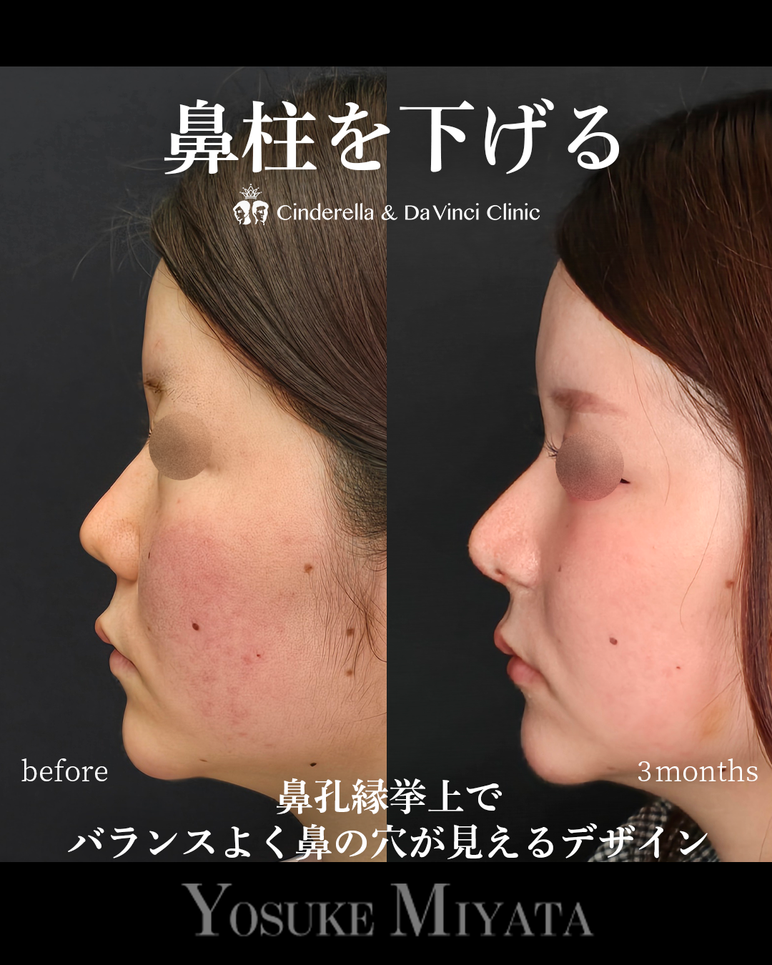 鼻柱を下げる鼻整形 | 名古屋の美容外科・美容皮膚科ならCinderella & Da Vinci Clinic【公式】