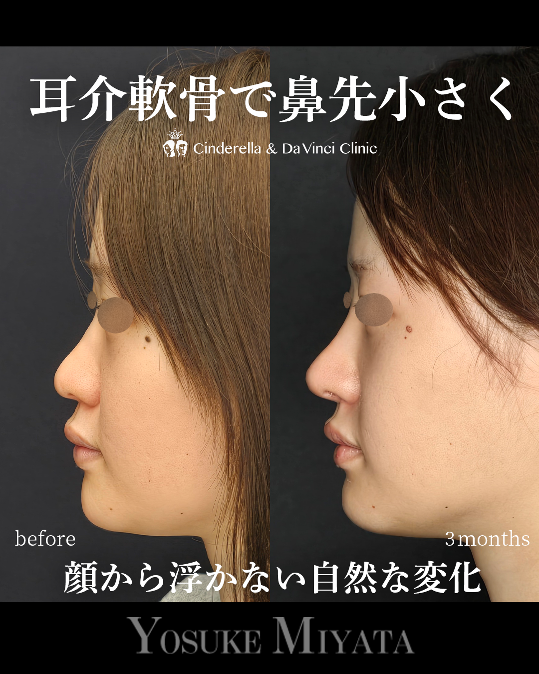 鼻先の丸み解消の画像