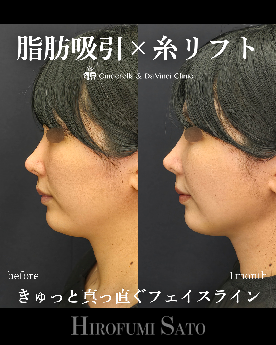 脂肪吸引と糸リフトの画像