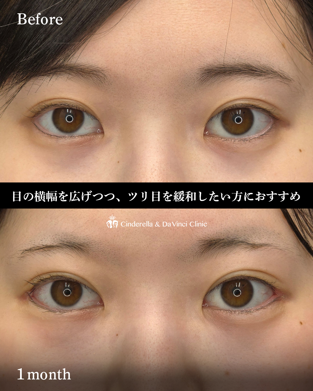 タレ目尻切開の画像