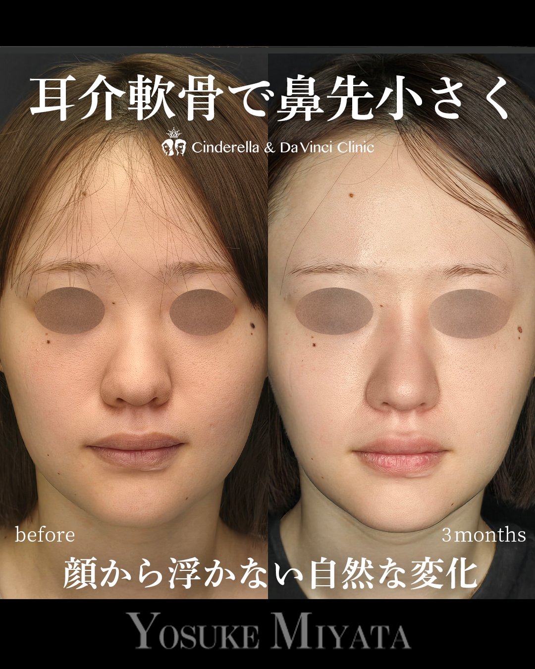 鼻先の丸み解消の画像