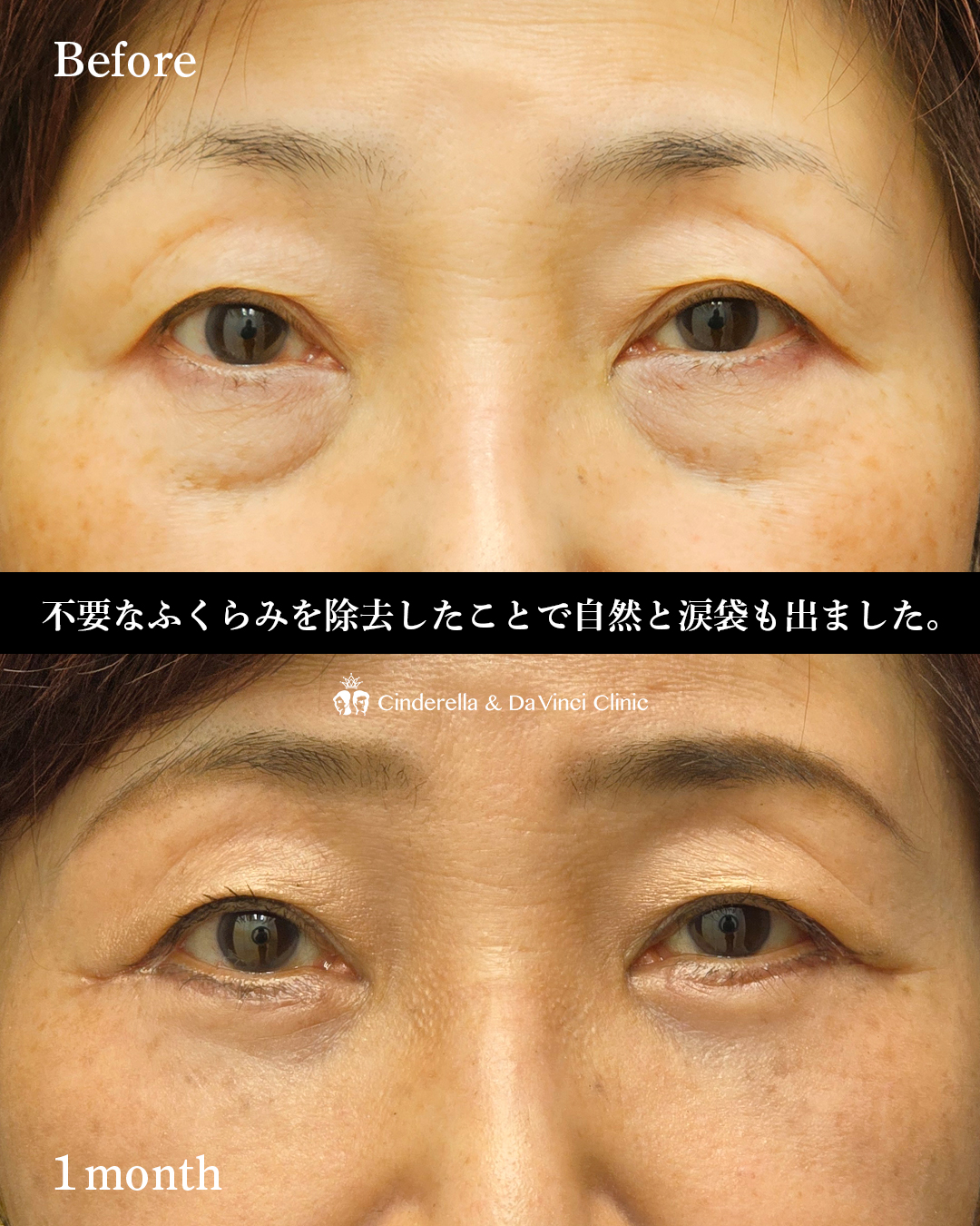 皮膚を切るクマ取りの画像