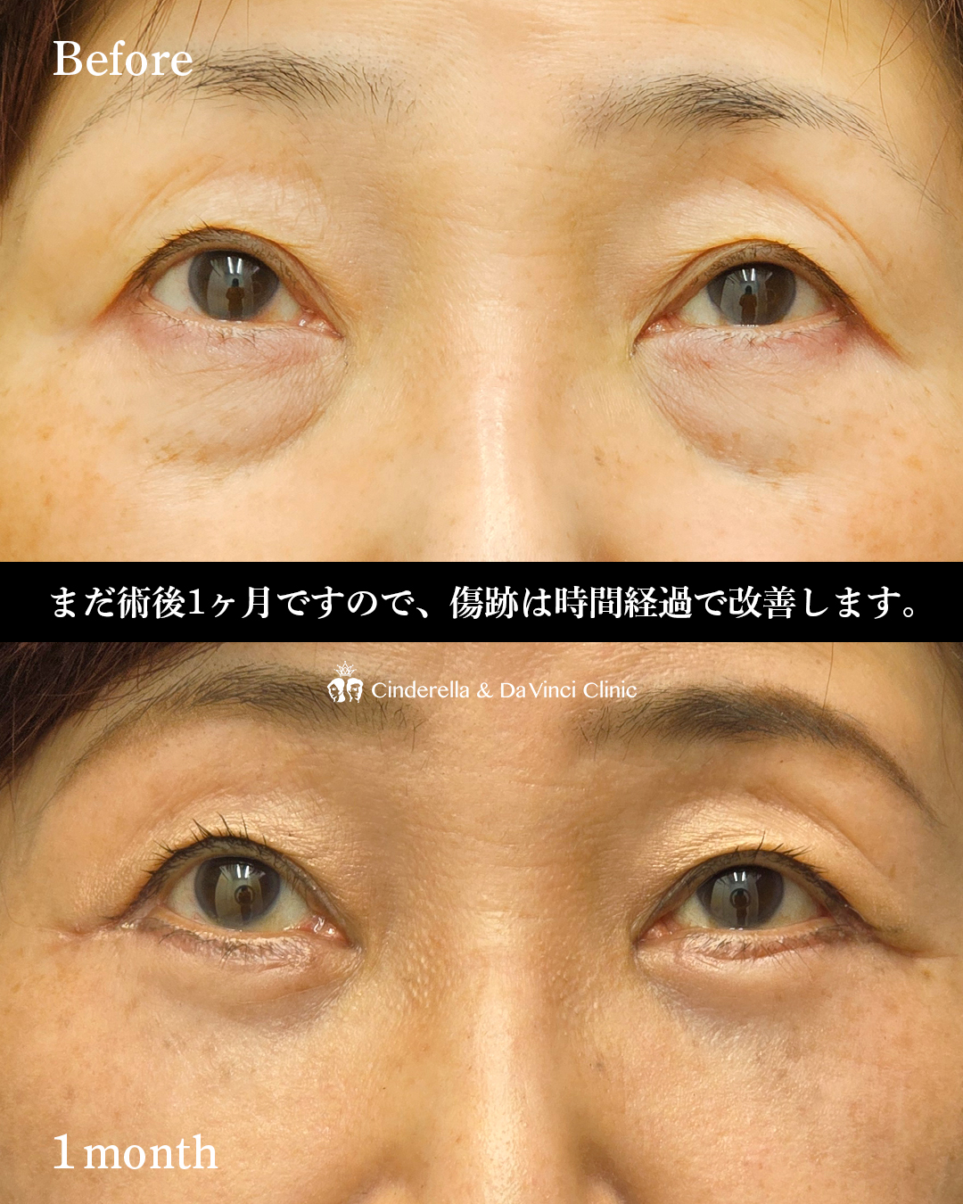 皮膚を切るクマ取りの画像