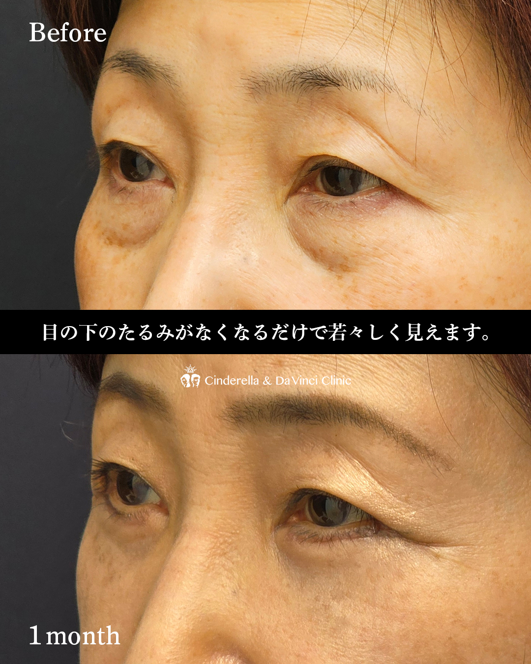 皮膚を切るクマ取りの画像
