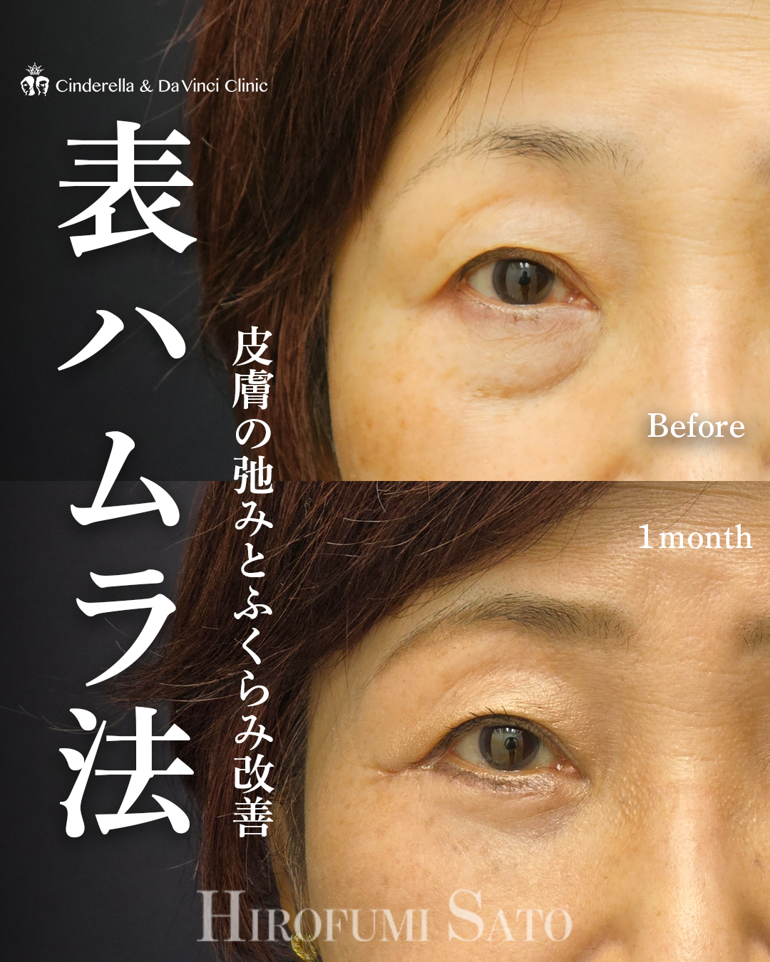 皮膚を切るクマ取りの画像