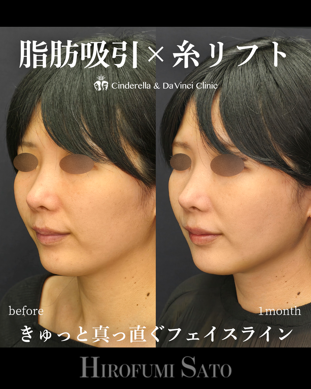 脂肪吸引と糸リフトの画像
