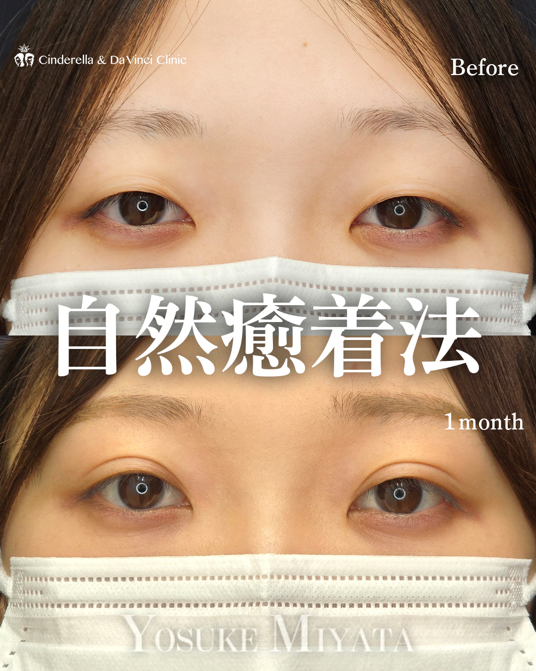 埋没で自然な二重の画像