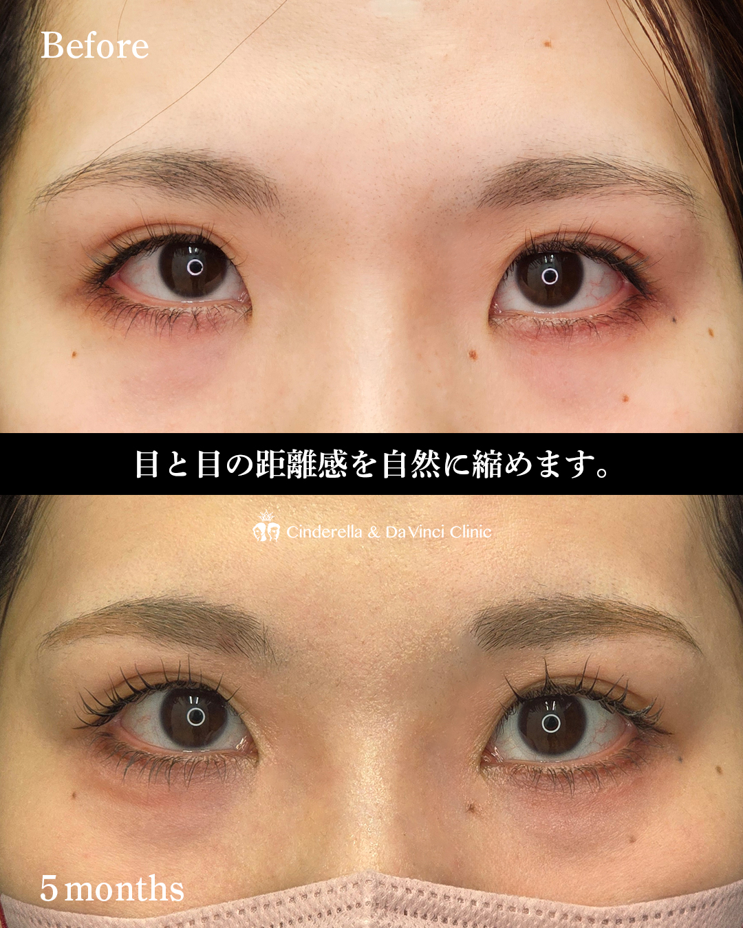目頭切開の傷跡変化の画像