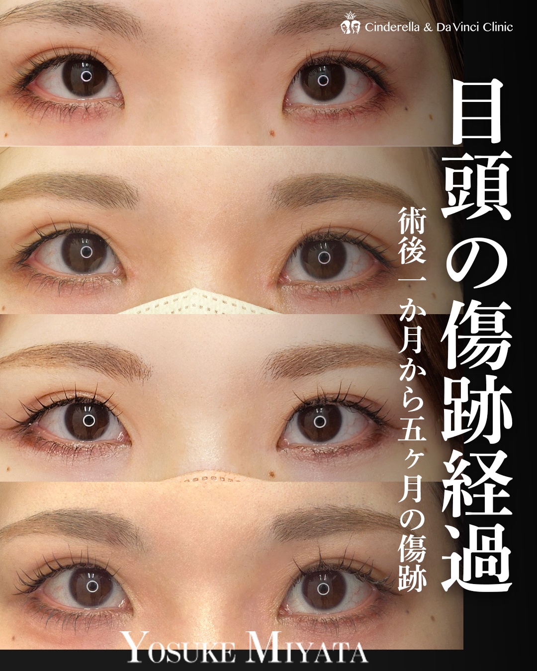 目頭切開の傷跡変化の画像