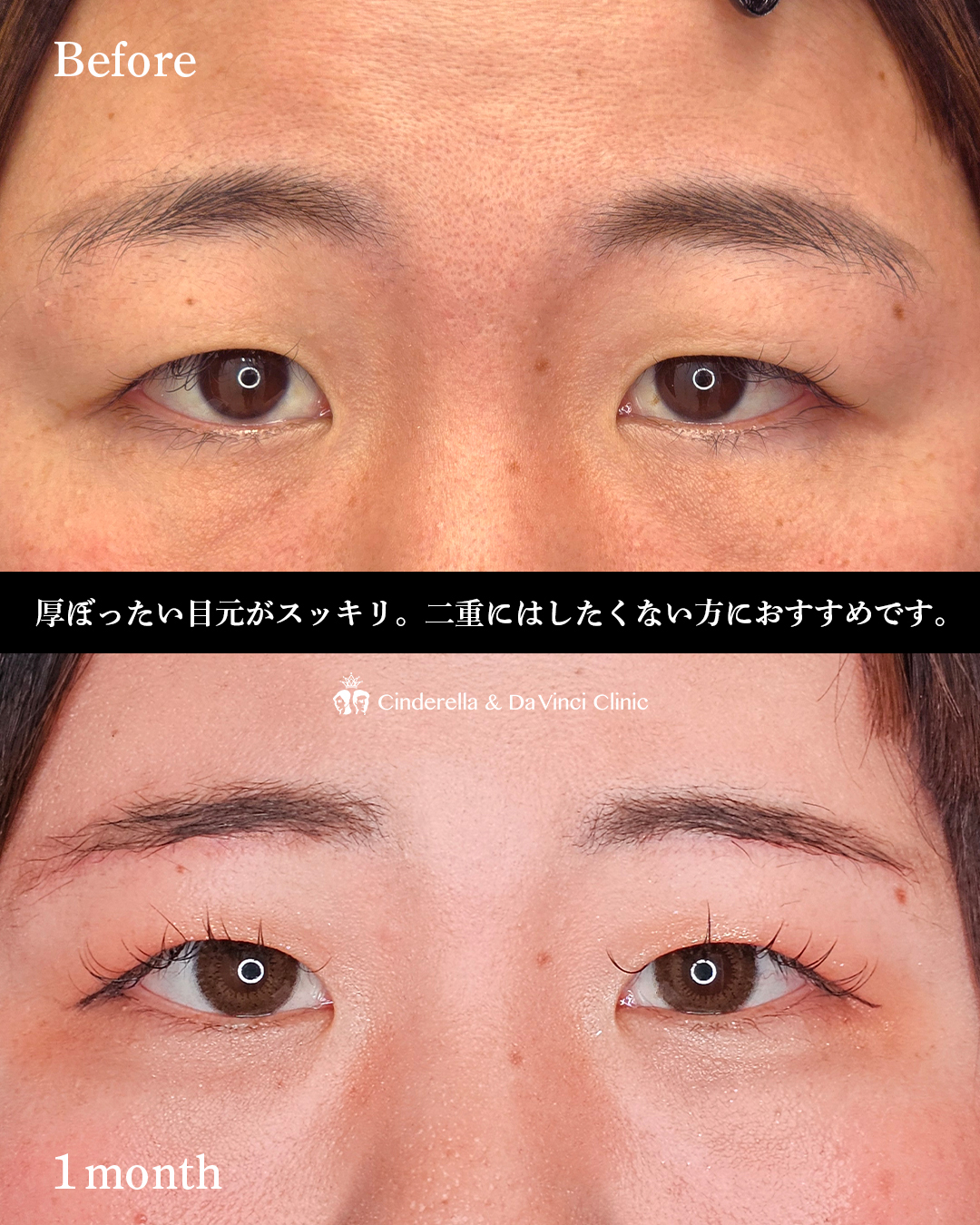 まぶたの厚み改善の画像