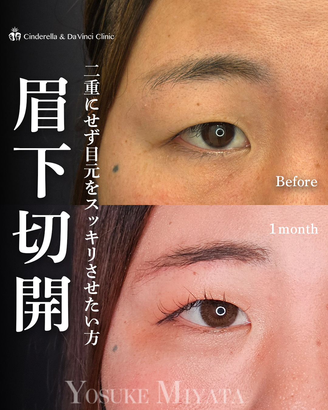 まぶたの厚み改善の画像