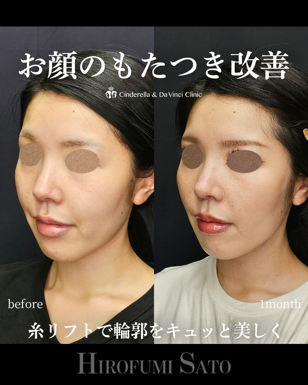 糸リフトでお顔のもたつき改善の画像
