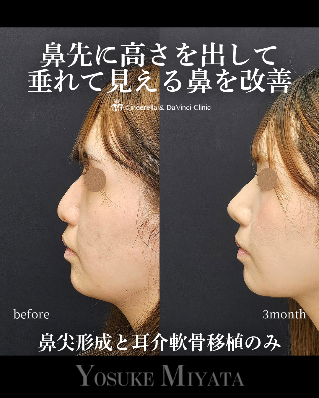 鼻先高く垂れ改善の画像