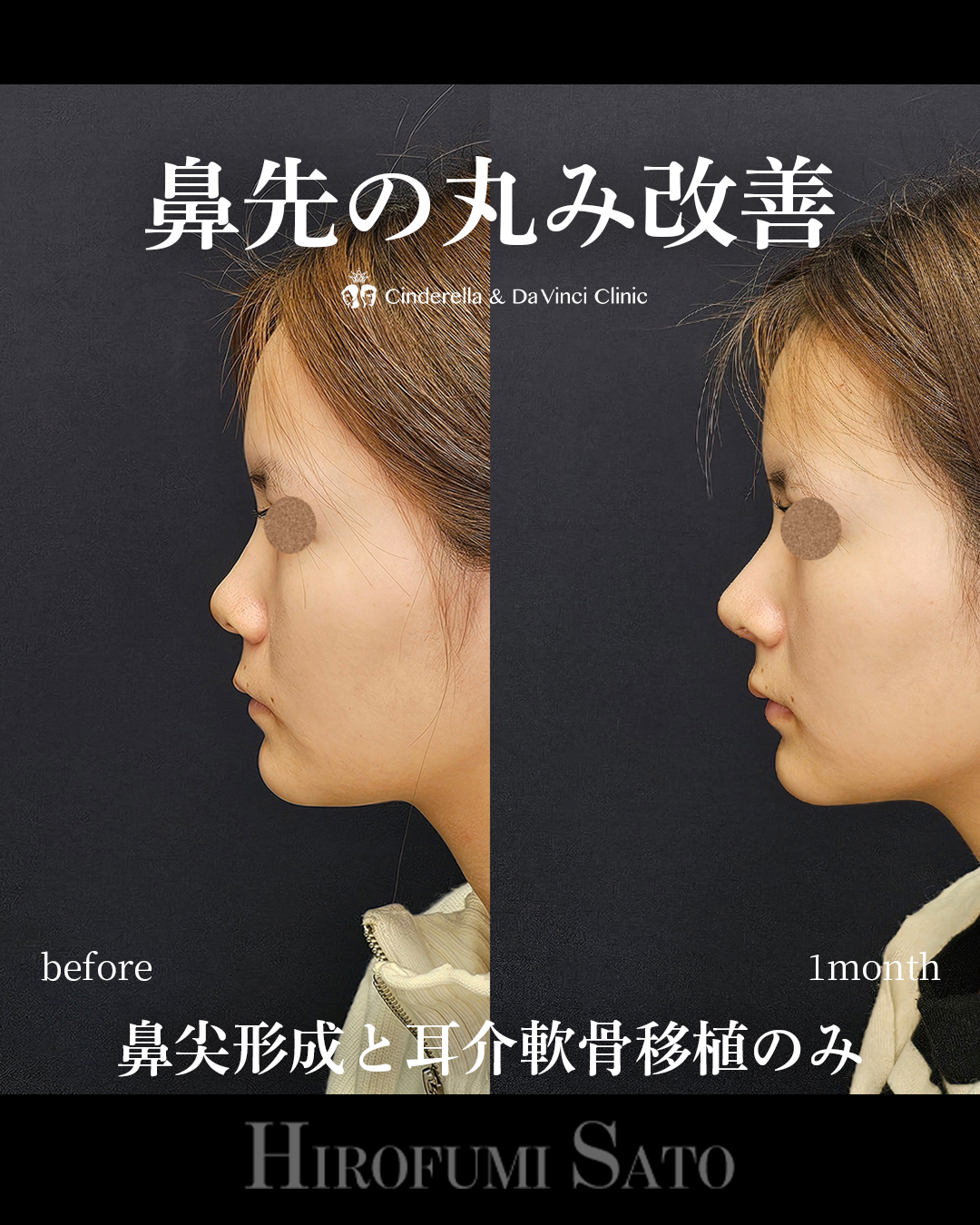 鼻先の丸み改善の画像