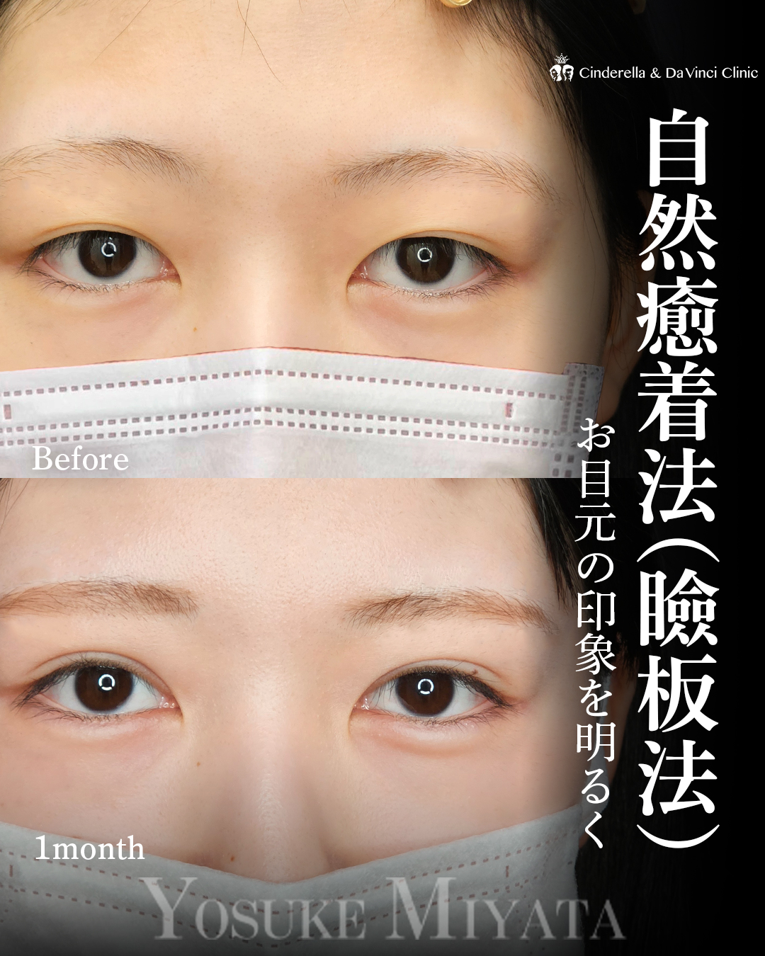 埋没で明るいお目元の画像