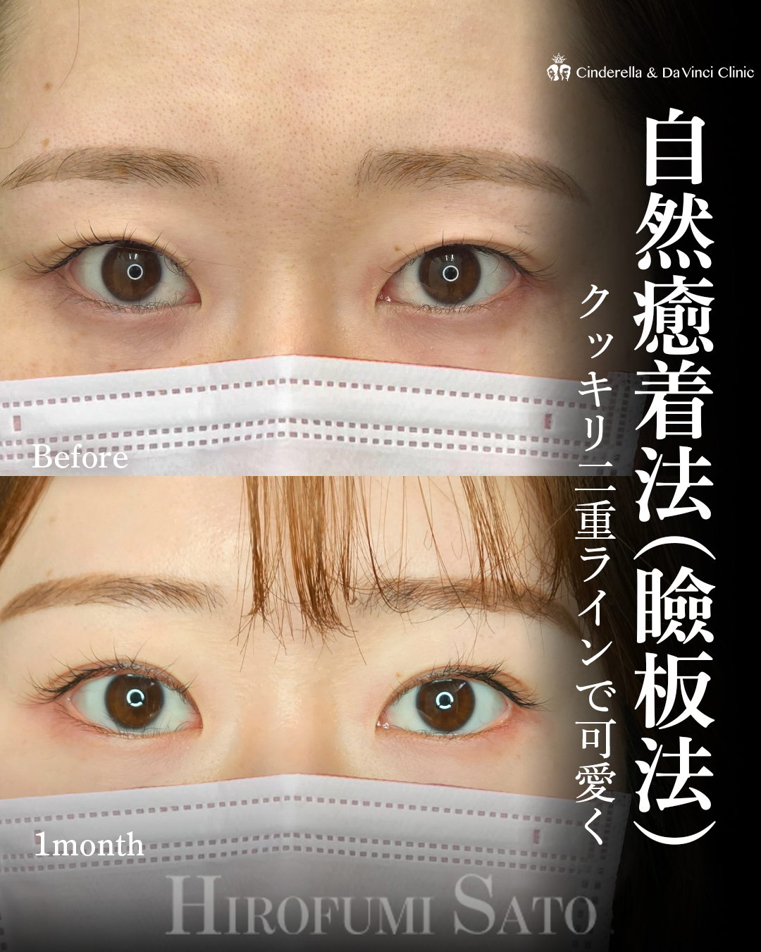 くっきり二重ラインの画像