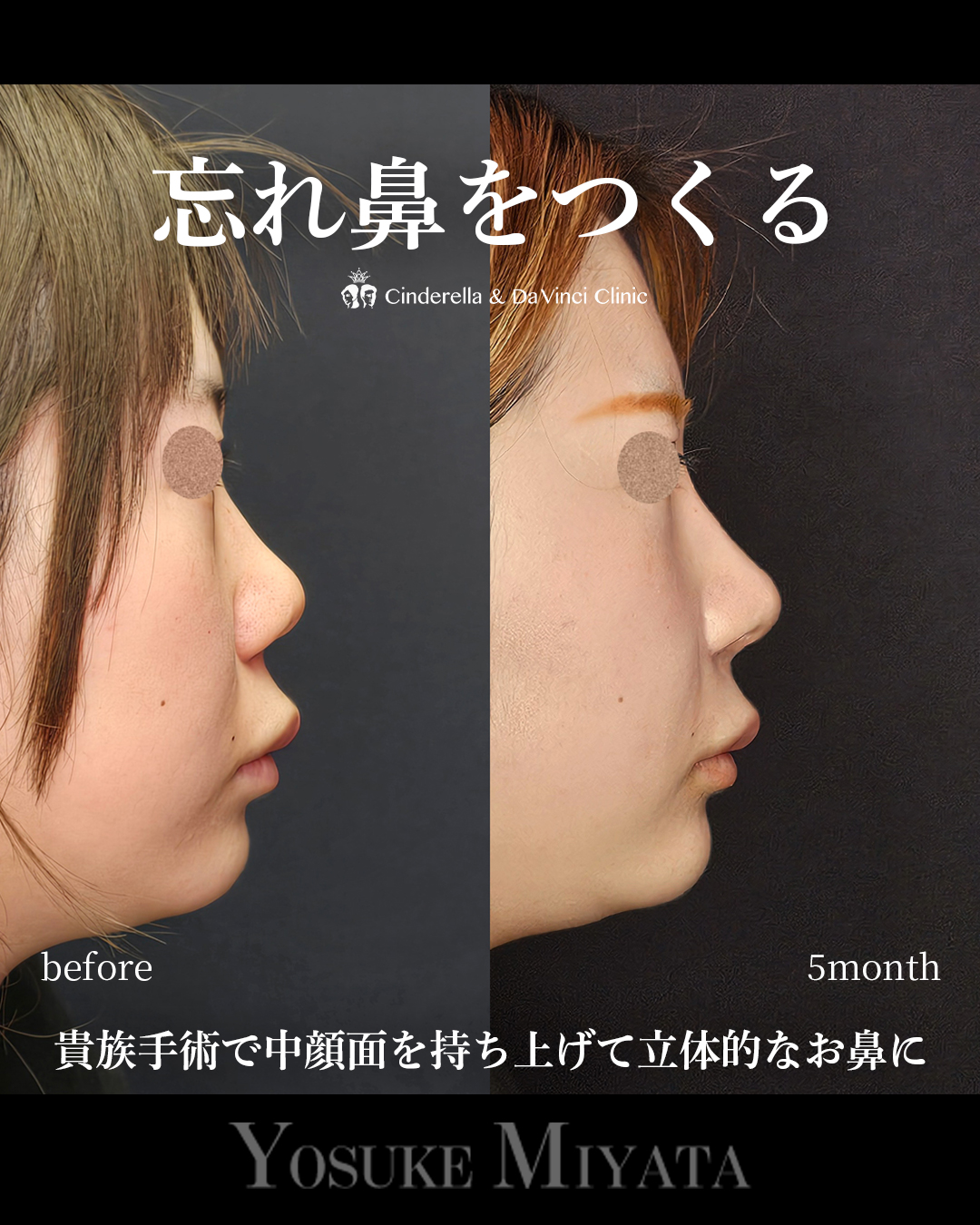 鼻整形で忘れ鼻にの画像
