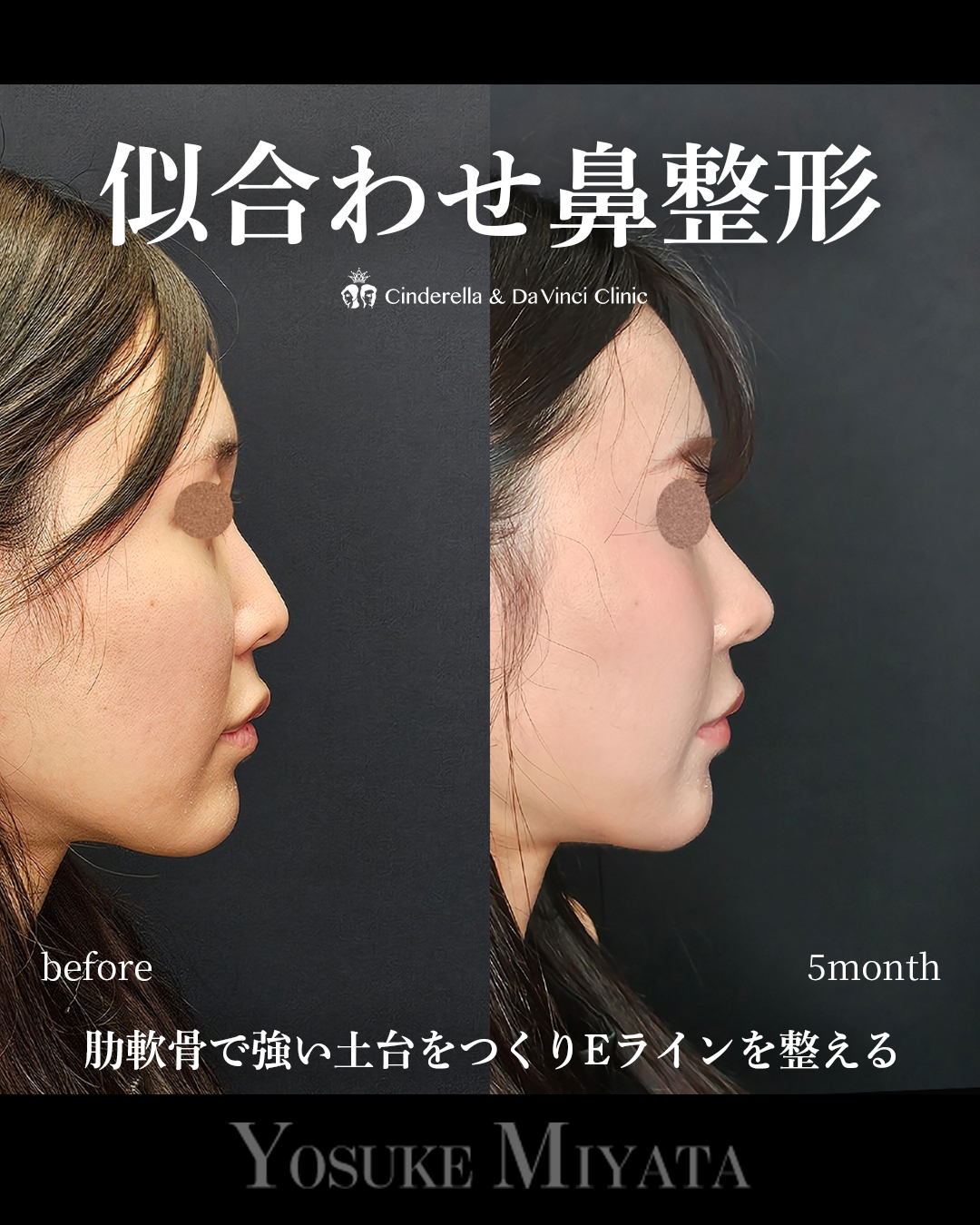 似合わせ鼻整形の画像