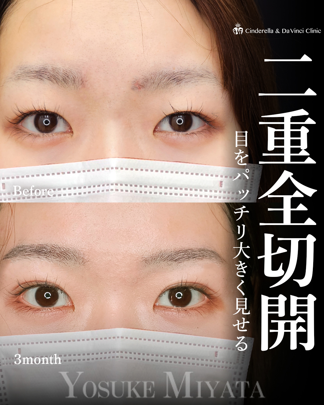 きれいな二重切開の画像