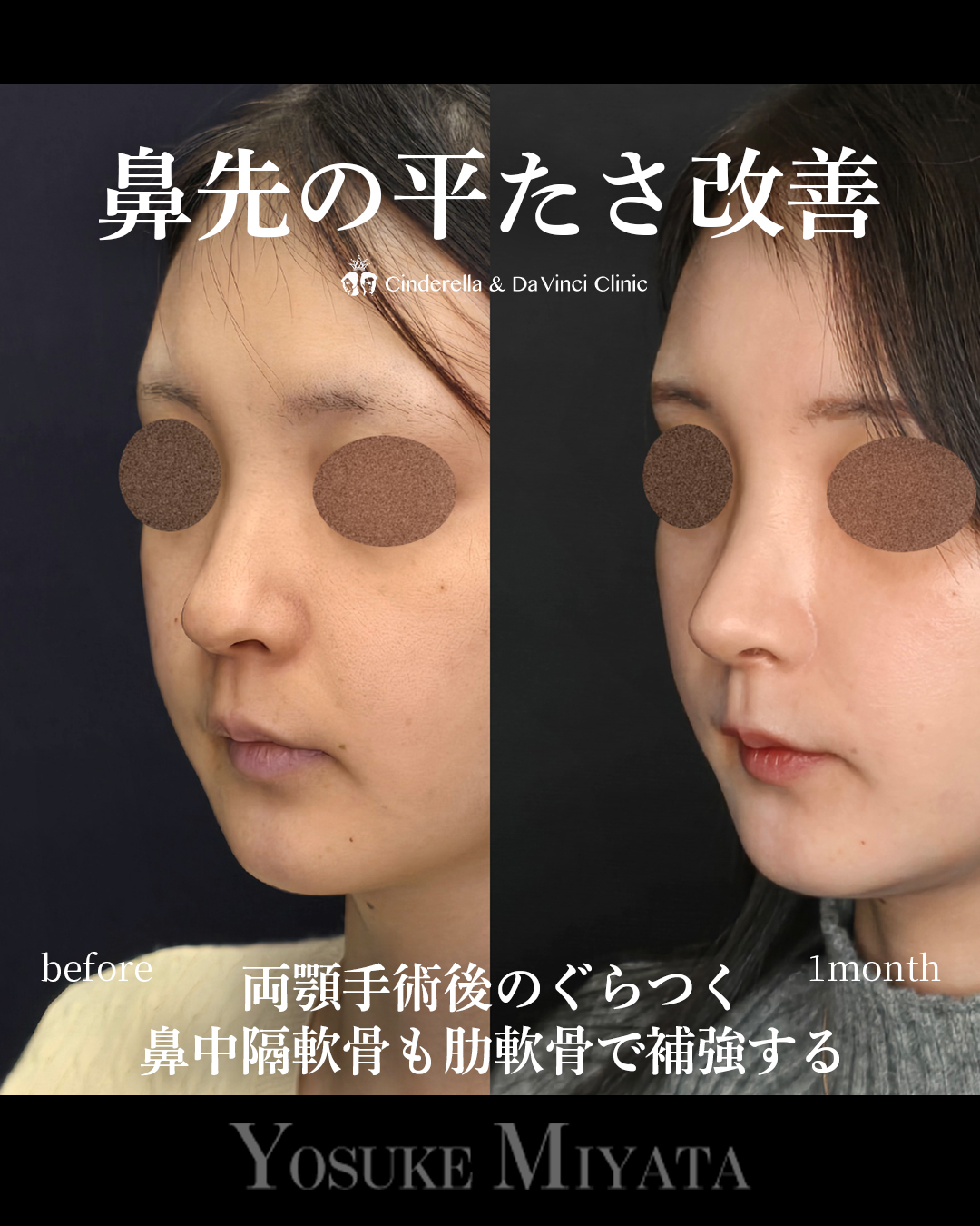 鼻先の平たさ改善の画像