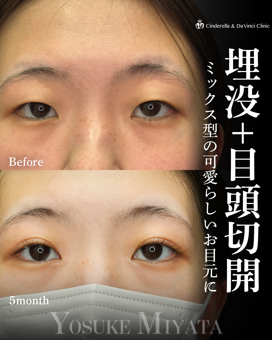 理想の二重にの画像