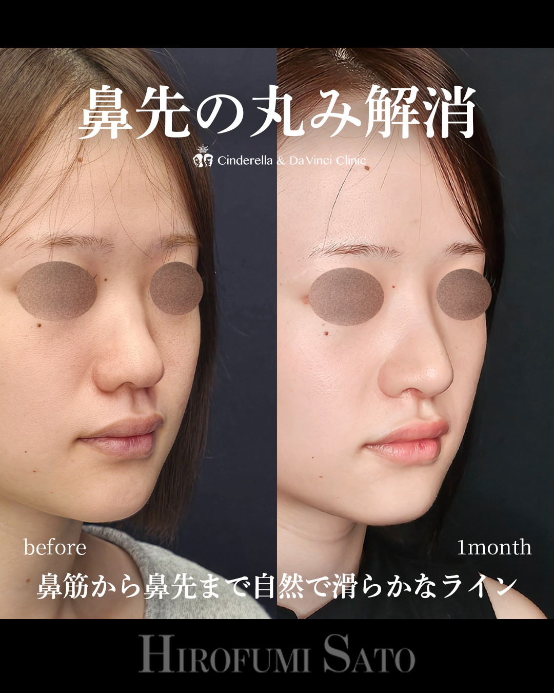 鼻先の丸み解消の画像