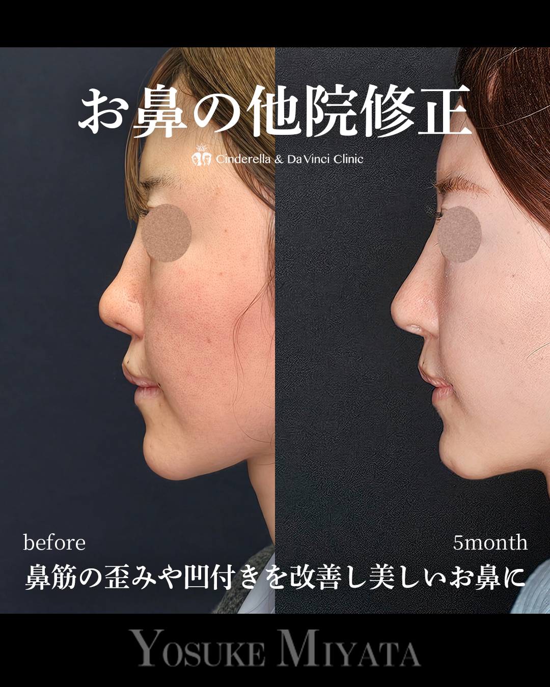 お鼻の他院修正の画像