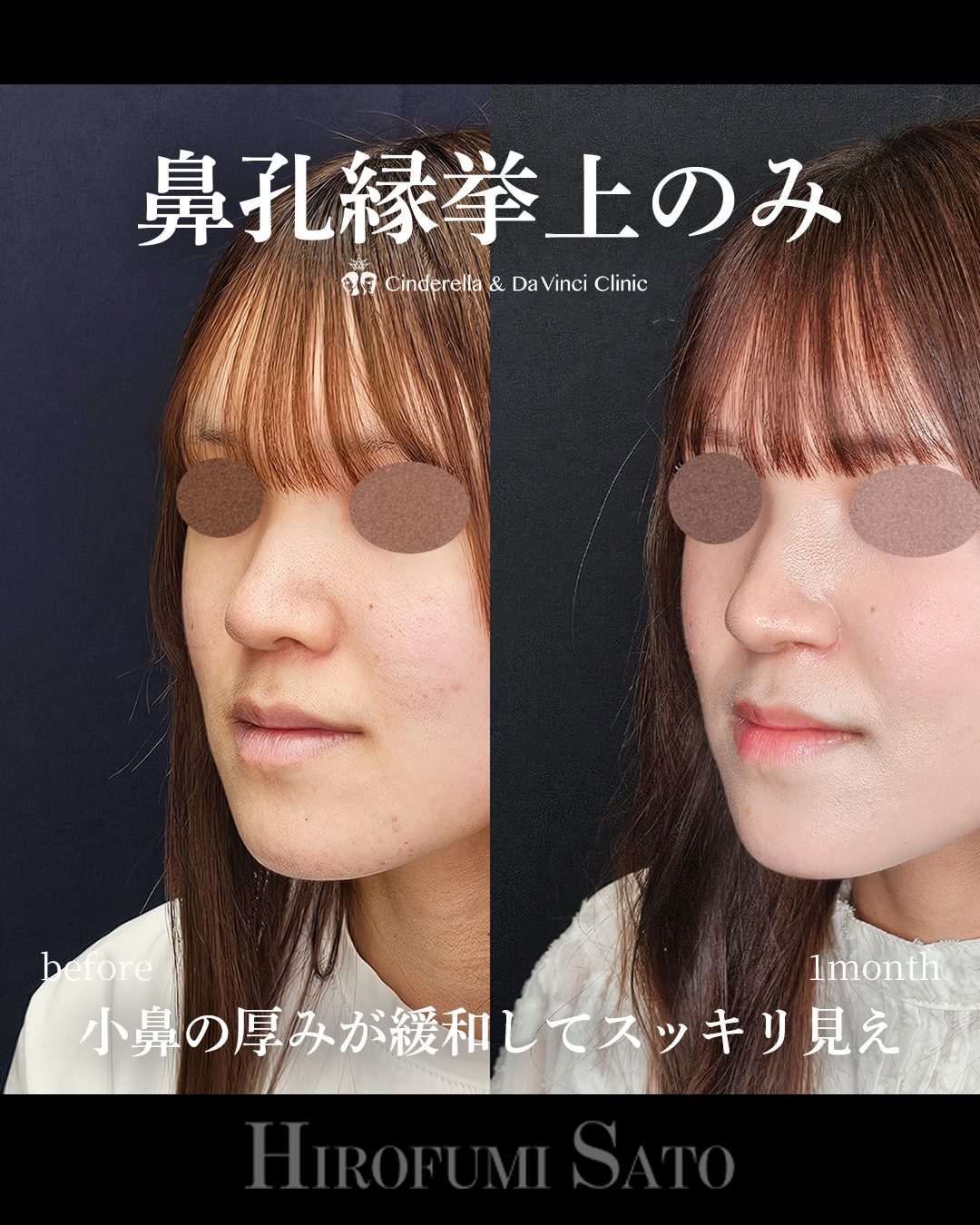 鼻孔縁挙上のみの画像