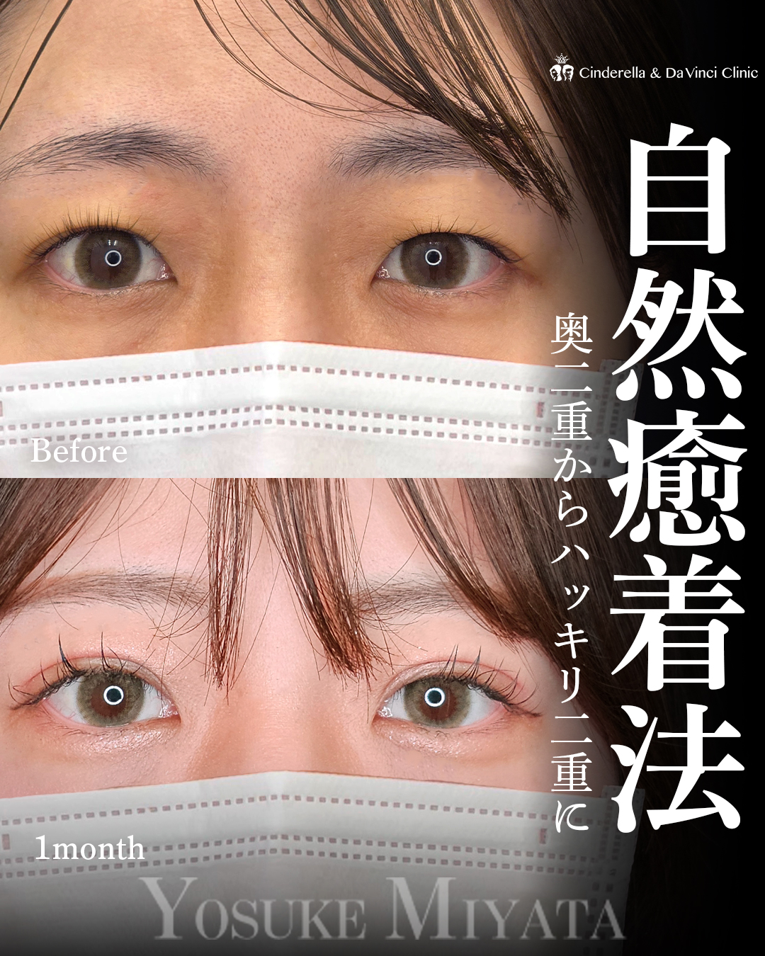 ハッキリ二重にの画像