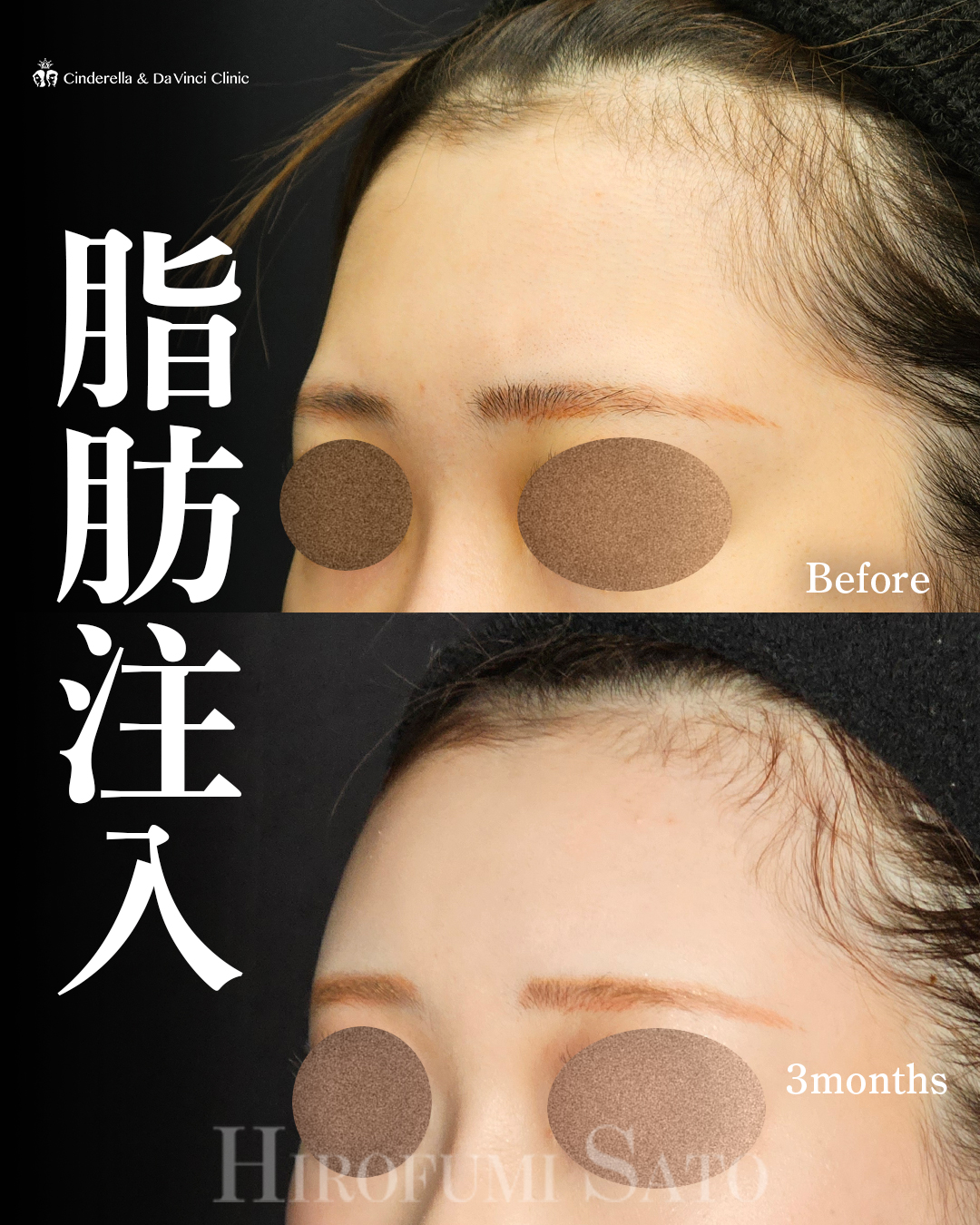 おでこの脂肪注入の画像
