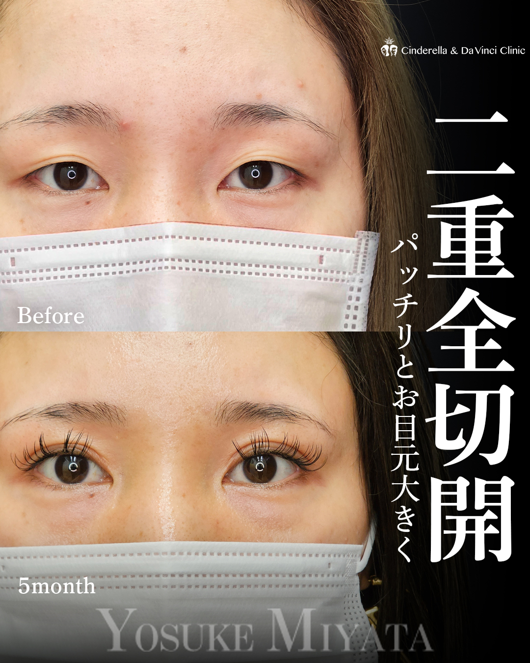 全切開で目元大きくの画像