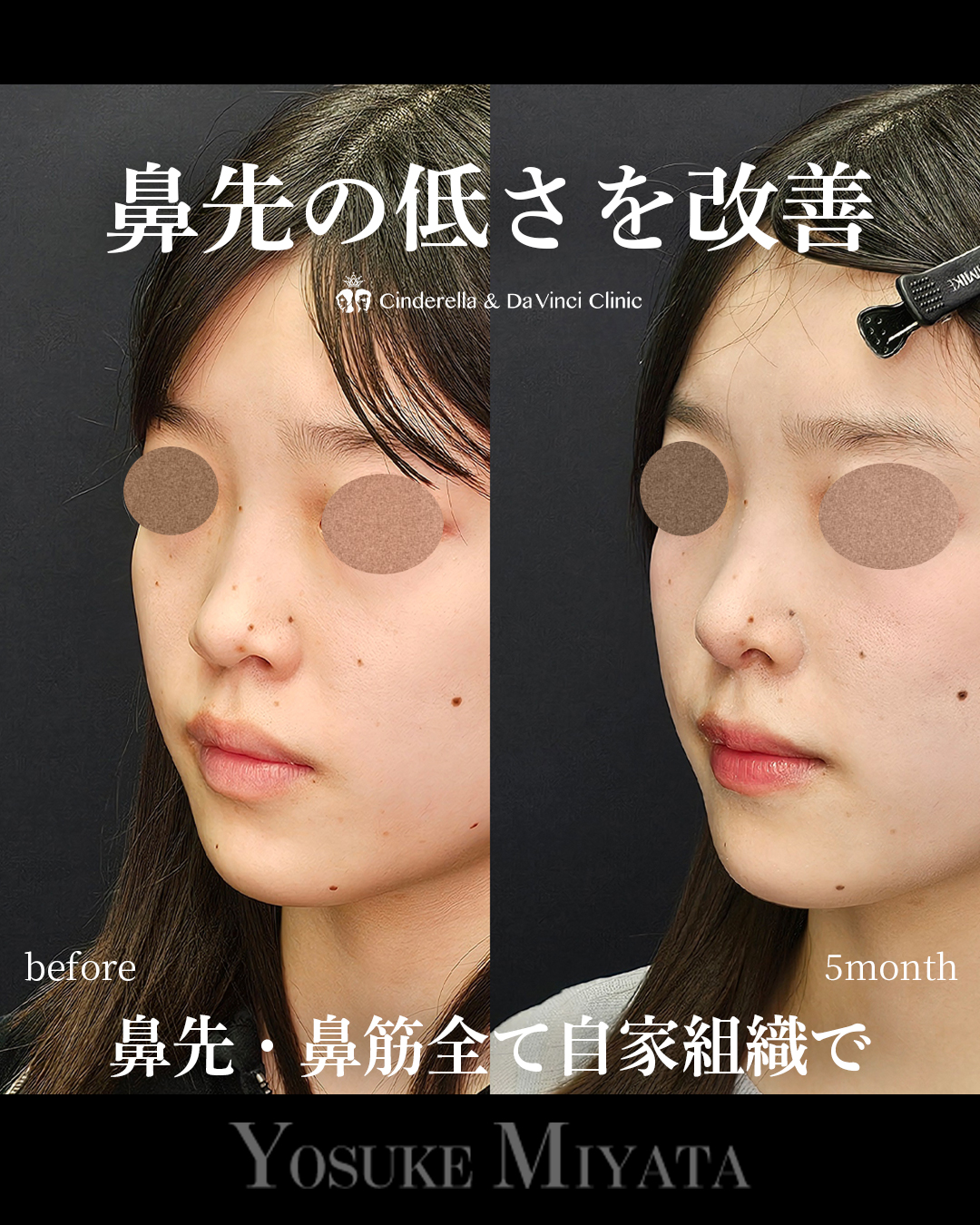 鼻先の低さ改善の画像