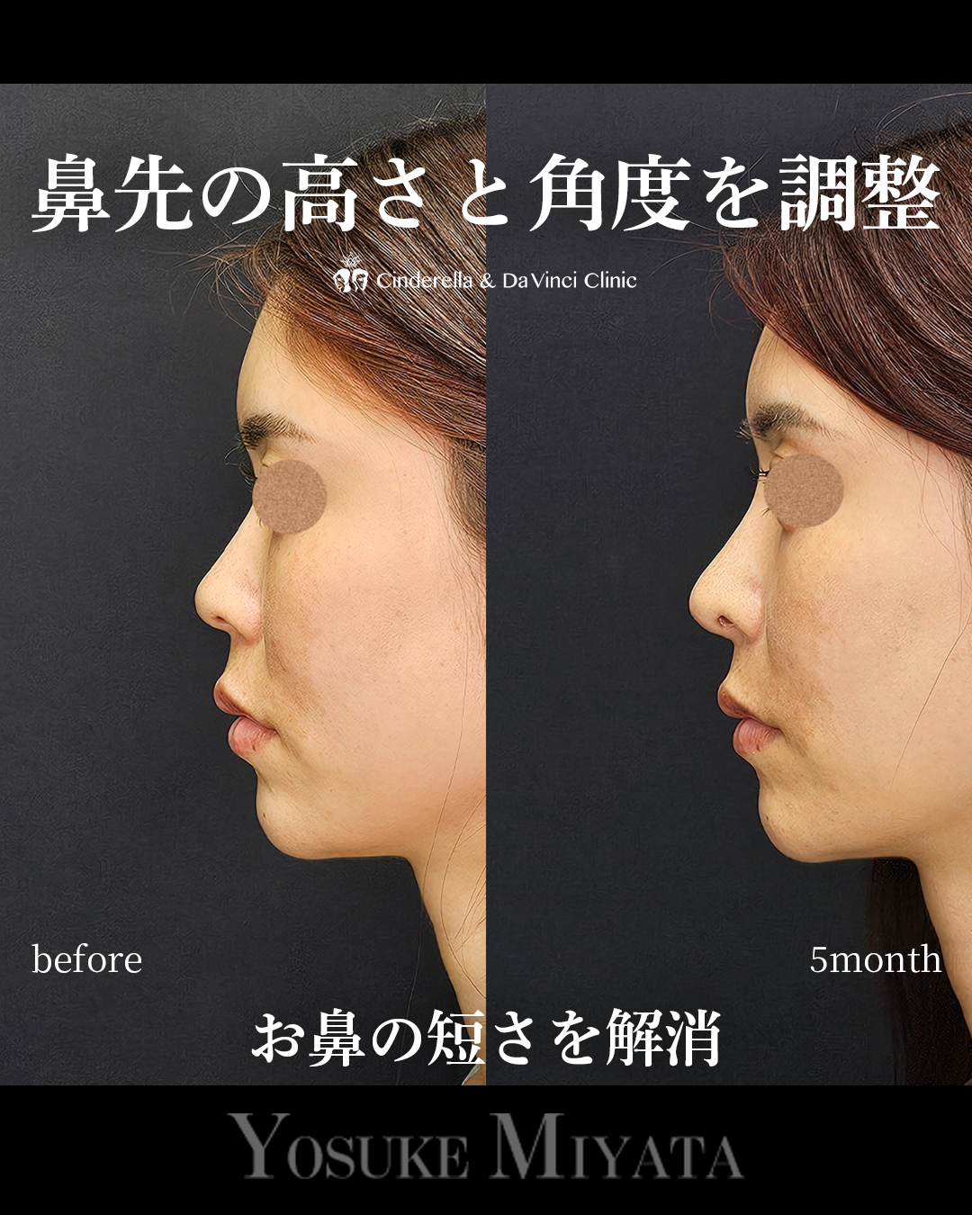短い鼻を改善するの画像